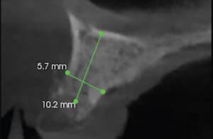 FIGURE 4. Available bone tooth #4 area.