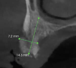 FIGURE 5. Available bone tooth #7 area.