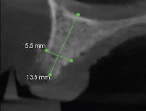 FIGURE 6. Available bone tooth #10 area.