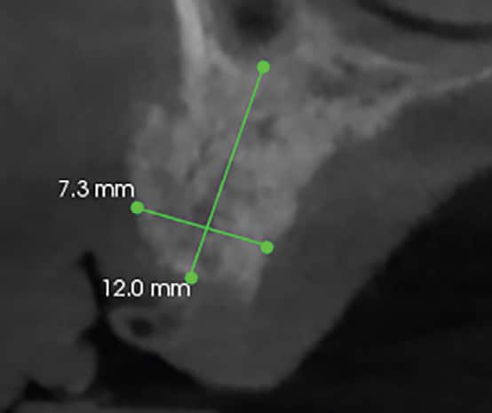 FIGURE 7. Available bone tooth #13 area.