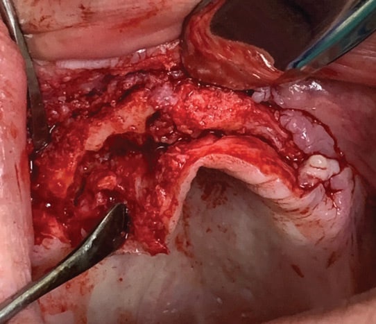 FIGURE 8. Exposed maxillary ridge (preimplant).