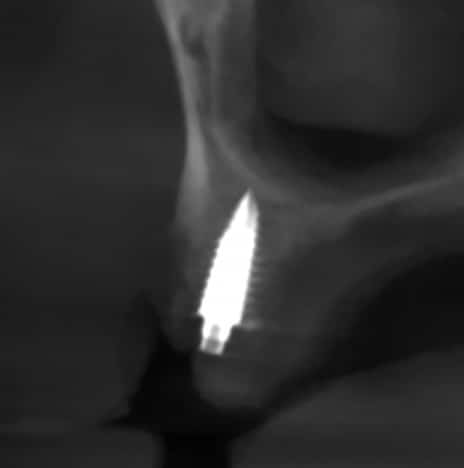 FIGURE 9. Immediate sinus lift tooth #4 area.