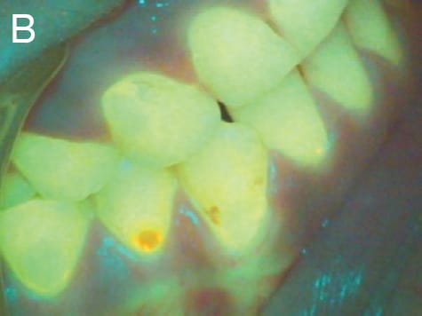 FIGURE 2B. The orange fluoresence exemplifies mature biofilm and calculus.