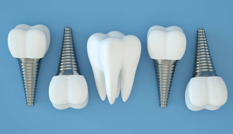 tooth-implants