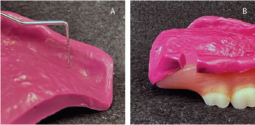 Clinical Considerations for Relining a Complete Denture - Decisions in  Dentistry