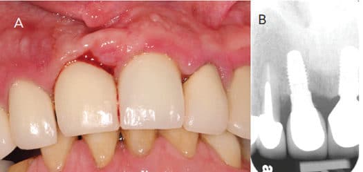 FIGURE 6. Marginal gingival inflammation (A) and bone loss (B) on implant #8.