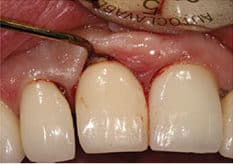 FIGURE 7. Residual excess cement on implant #8.