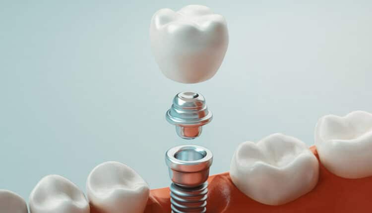 rendering-of-implants