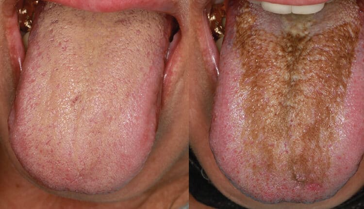 curing acid bumps on tongue