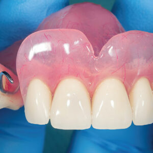 DENTAL PROSTHESES