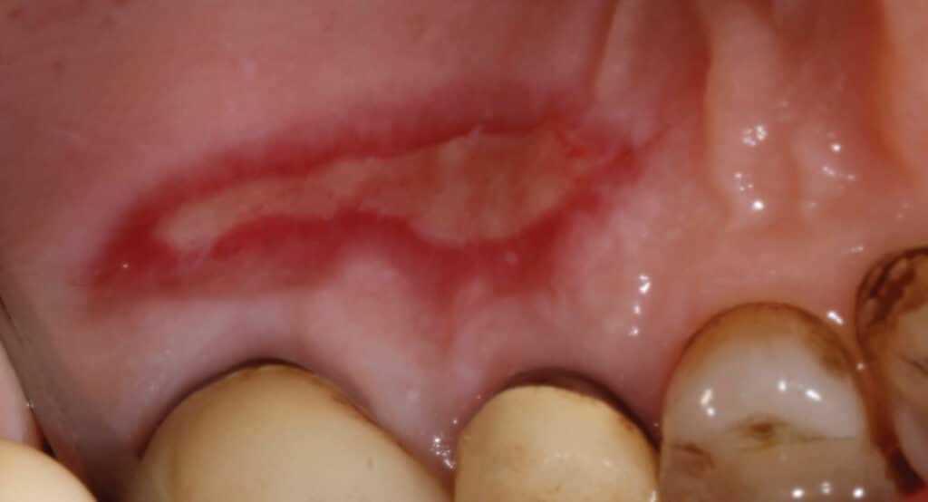 FIGURE 1. Palatal wound healing at the donor site via secondary intention after soft tissue graft harvest.