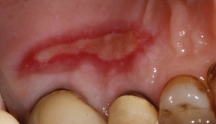 Multi-colour disclosing of dental plaque. Left: clinical image showing