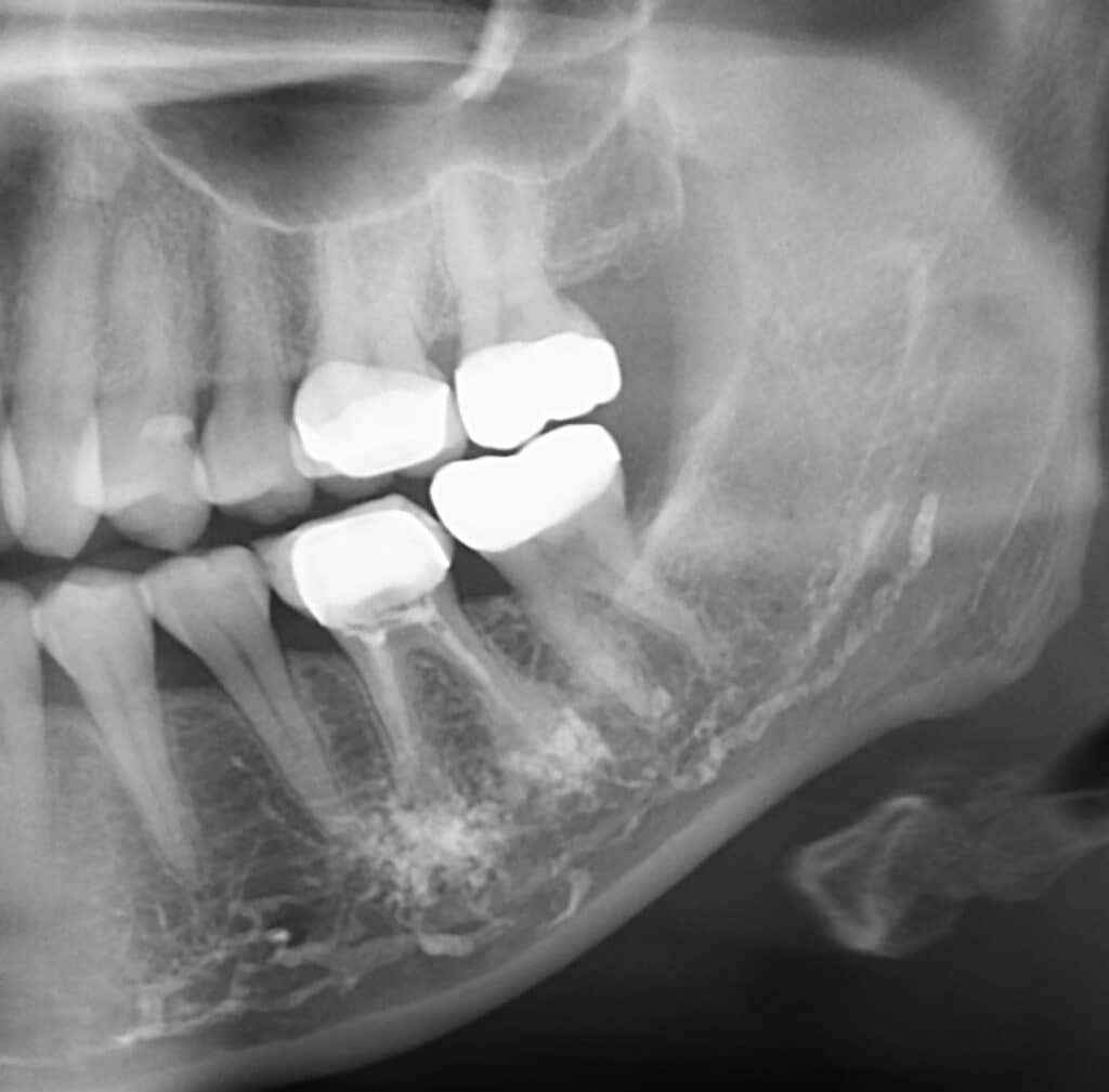 Overview and Management Of Endodontic Iatrogenic Extrusions Decisions