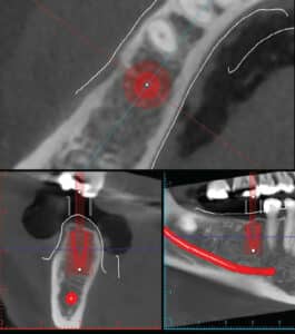 FIGURE 1. Cone beam computed tomography showing a virtual dental implant workup. Bone availability and quality can be assessed, as well as the location of vital structures. From this, and with appropriate software, a computer-generated surgical guide can be fabricated.