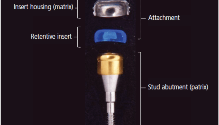 Over-Denture O-Ring and Locator Replacement Service