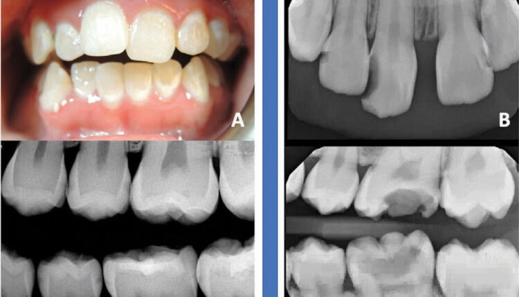 dental caries progression