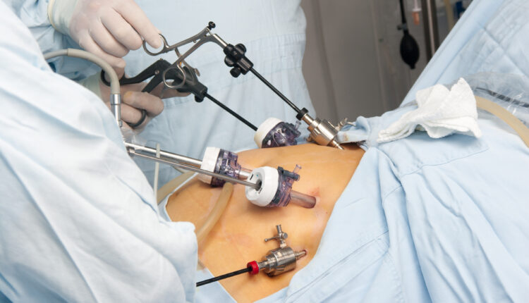 Gastric bypass surgery