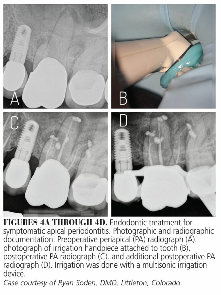 New Paradigms in Endodontic Irrigation - Decisions in Dentistry