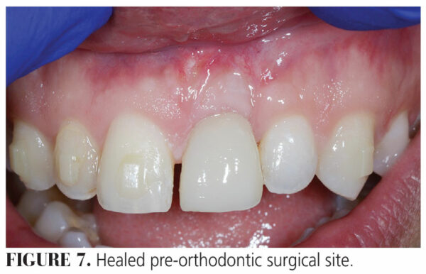 Single Recession Defect Recession Defects on a Maxillary Single Tooth Implant - Decisions in ...