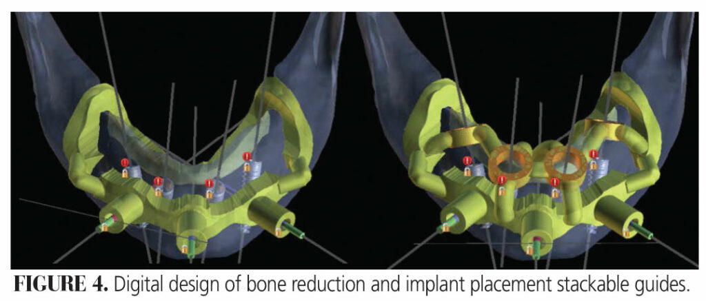 CAD/CAM-Driven Full-Arch Restorations - Decisions in Dentistry