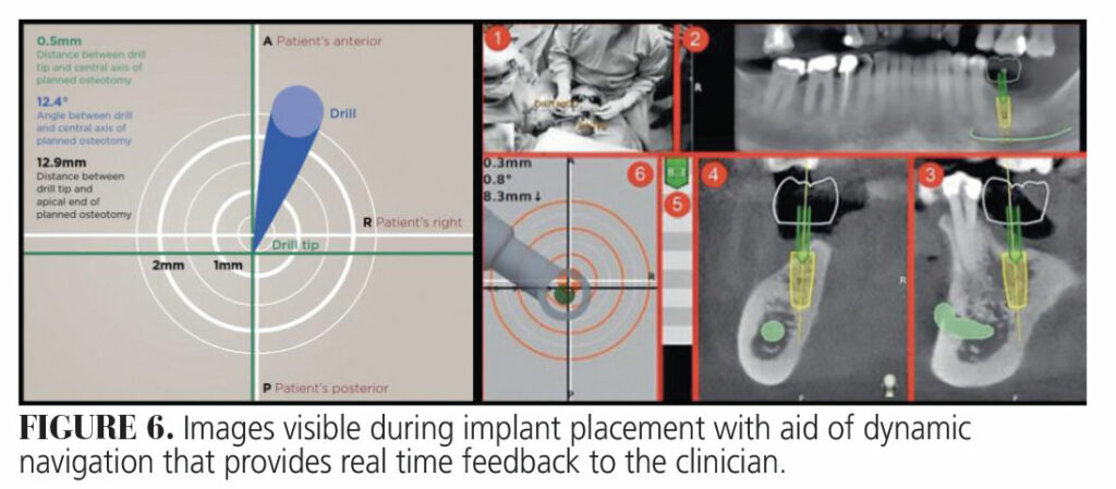 CAD/CAM-Driven Full-Arch Restorations - Decisions in Dentistry