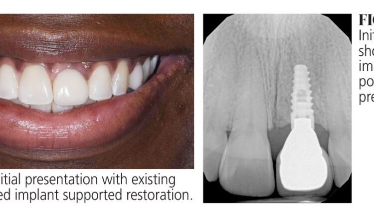 020_anterior-implant_18-21-(Page-20)