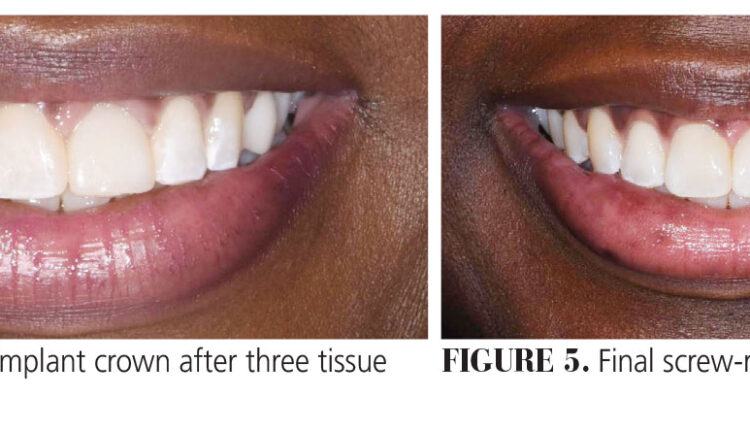021_anterior-implant_18-21-(Page-21)-2