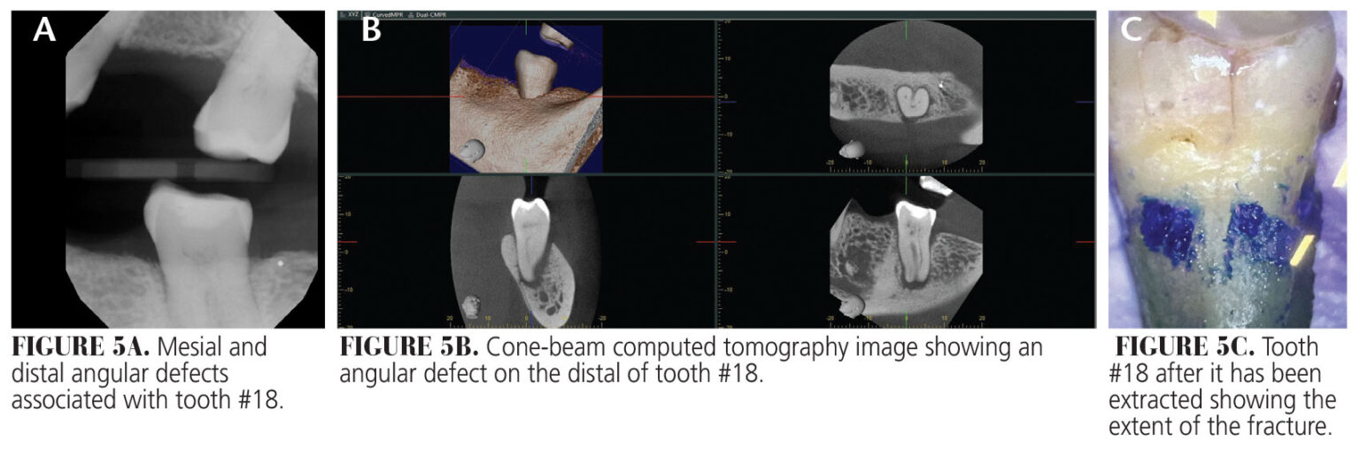 Early Detection Is Key to Preserving Tooth Structure - Decisions in ...