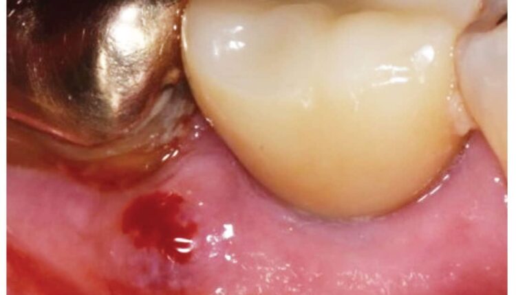 036_PeriImplantitisCE_36-41-Page-36