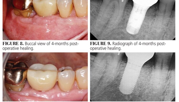 040_PeriImplantitisCE_36-41-Page-40