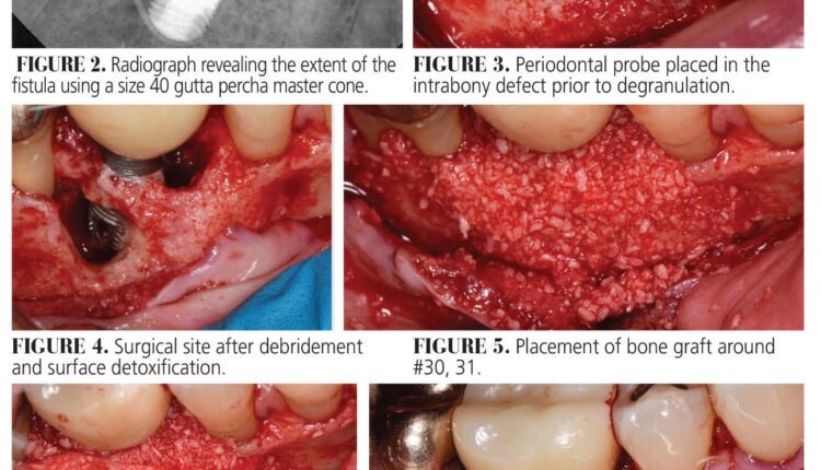 040_PeriImplantitisCE_36-41-Page-40-copy