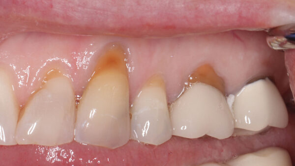 Managing Complications in Gingival Recession