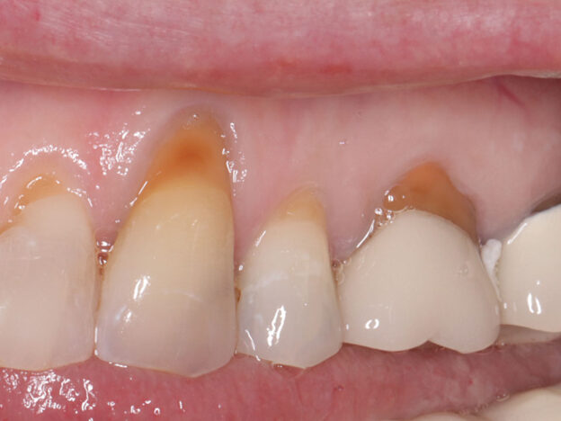Managing Complications in Gingival Recession course image