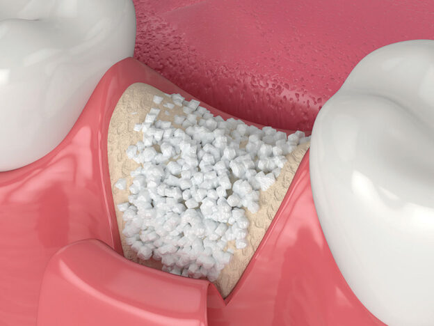 Achieving Predictable Bone Regeneration Without Autogenous Grafts course image
