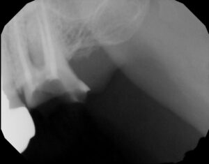 Figure 5A Pre-op