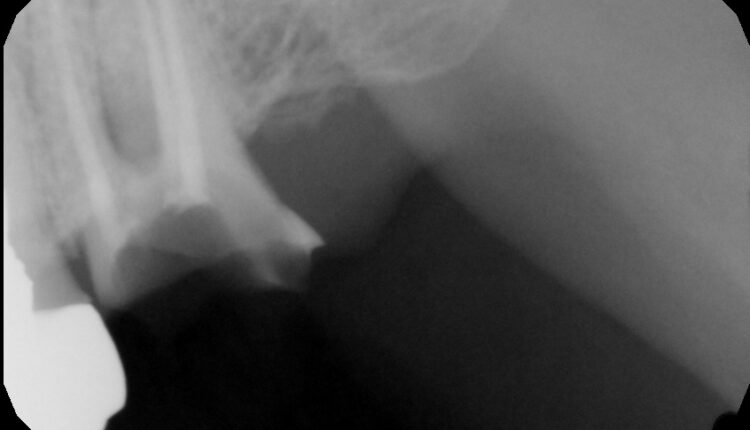 10. Figure 5A.Preop