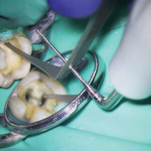Mastering the Art of Broken File Retrieval in Endodontics