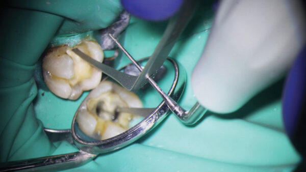 Mastering the Art of Broken File Retrieval in Endodontics