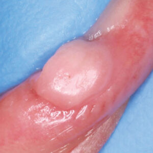 Minimally Invasive Removal of a Traumatic Fibroma Using CO₂ and Diode Lasers