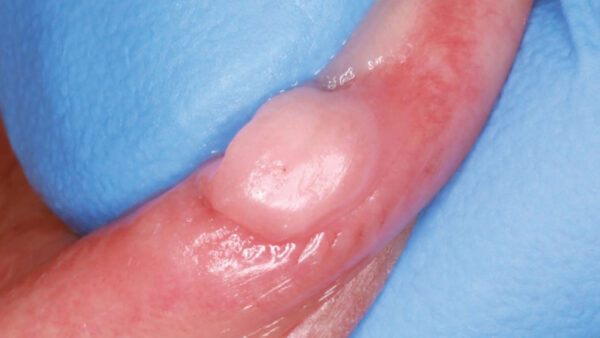 Minimally Invasive Removal of a Traumatic Fibroma Using CO₂ and Diode Lasers