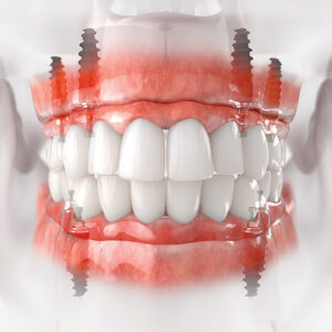 Precision Planning in Full-Arch Implant Rehabilitation