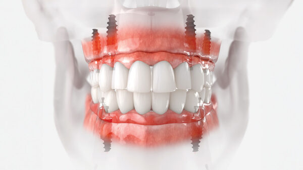Precision Planning in Full-Arch Implant Rehabilitation