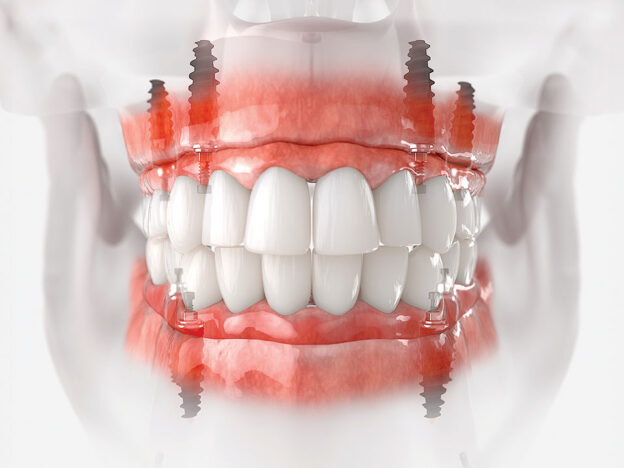 Precision Planning in Full-Arch Implant Rehabilitation course image