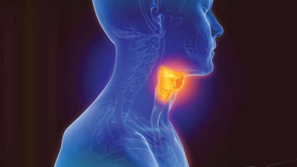 Managing Oral Mucositis