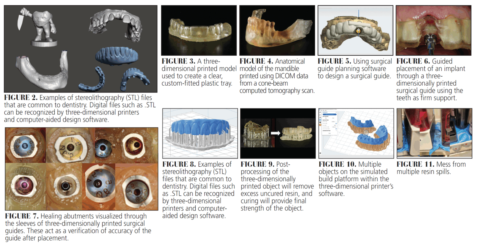 How 3D-Printing Is Reshaping the Dental Workflow - Decisions in Dentistry
