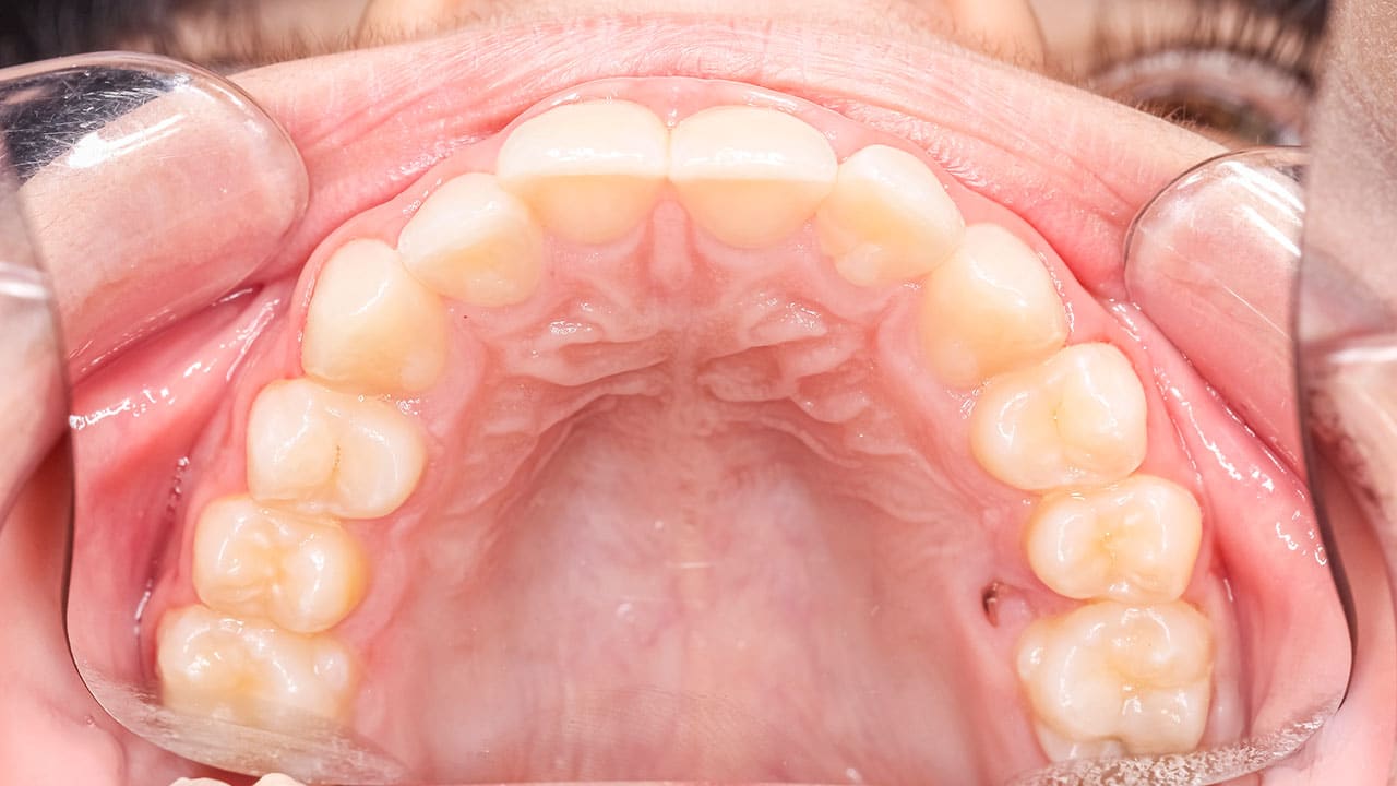 Navigating the Full-Arch Dilemma - Decisions in Dentistry