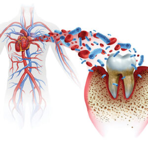 Periodontitis and Cardiovascular Diseases Are the Not-So-Silent Killers
