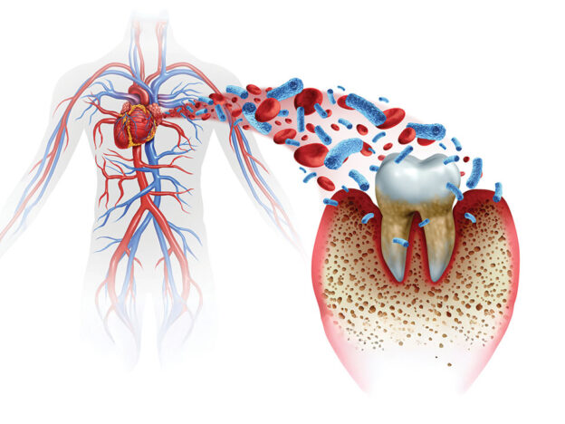 Periodontitis and Cardiovascular Diseases Are the Not-So-Silent Killers course image