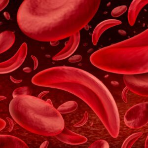 Sickle Cell Disease in the Dental Chair