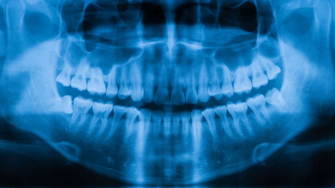 When a Tooth Extraction Becomes a Jaw-Threatening Risk